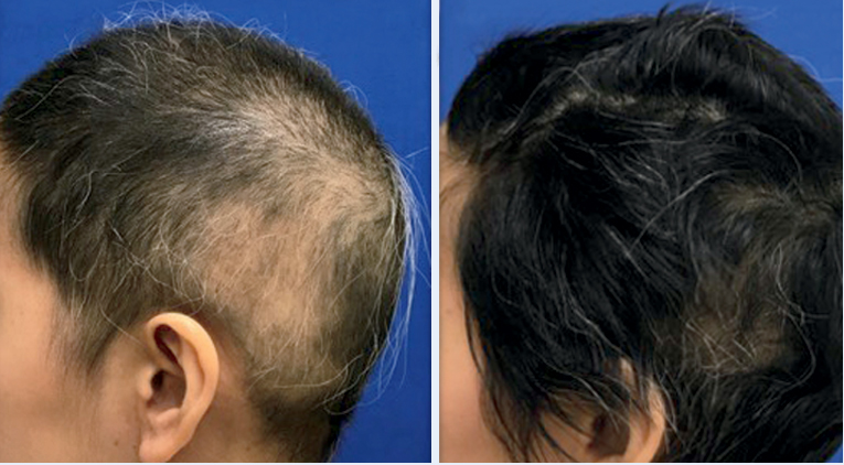 Hair Restoration – Texas Regional Clinic